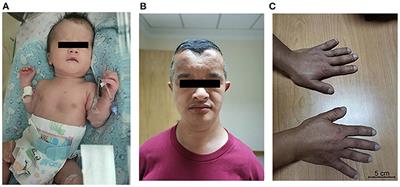 Cleidocranial Dysplasia Causing Respiratory Distress in Neonates: A Case Report and Literature Review